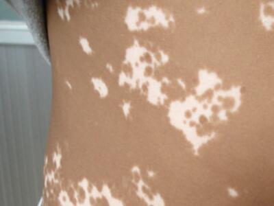 白癜风怎么治疗好的块”