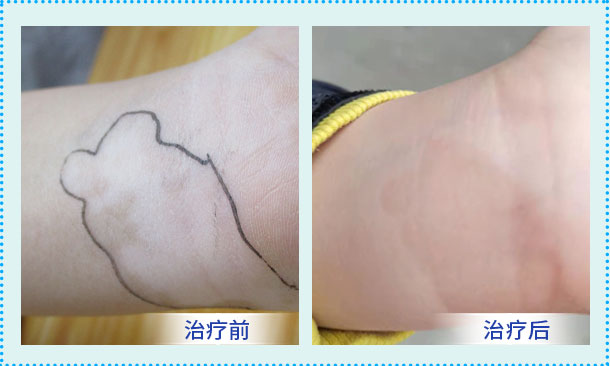 助力青少年儿童白癜风患者迎接美好青春!