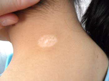 女性白癜风患者怀孕了怎么护理效果好”