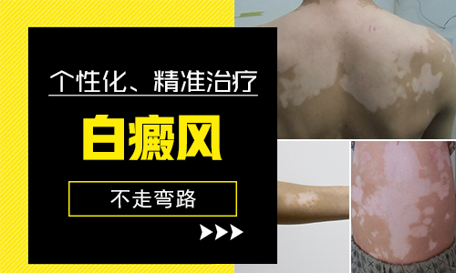 孩子长白癜风怎么办才好”