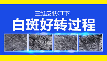 白癜风周围变黑是康复期的表现吗