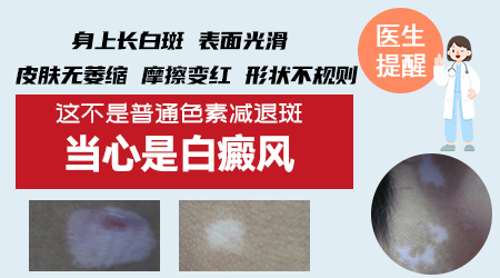 白癜风有没有不治疗自己恢复的”