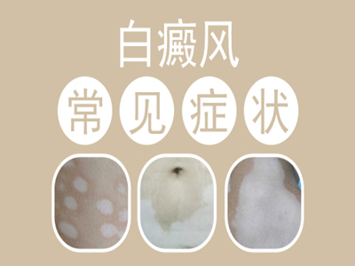 发展期的白癜风该要怎么治”