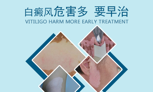 怎么治疗白癜风最好”