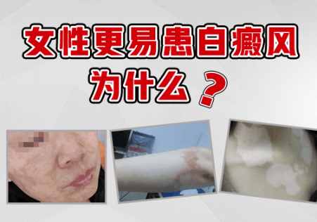 诊断女性白癜风的方法有哪些”