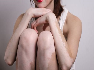 胸前患有白癜风怎么治疗”