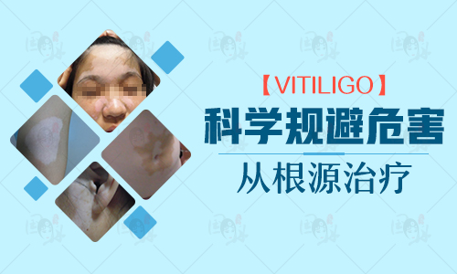 白斑治疗多长时间才能恢复”