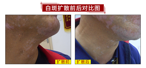 健康中秋·秋季白癜风诊疗