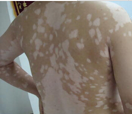 白癜风病情变重的原因有哪些”