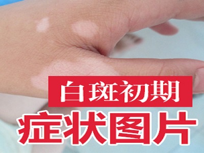 白癜风的早期症状都有哪些