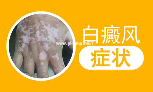 小孩身上有长白癜风该怎么治”