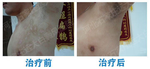 什么是完全性白癜风?