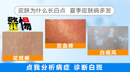 紫外线真的能治好白癜风吗 效果如何