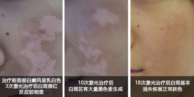 美国极速308nm准分子激光——治疗白癜风的核心技术”