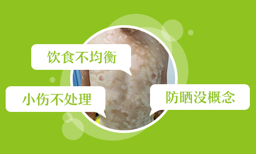白癜风扩散严重的原因是什么”