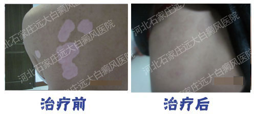 怎么判别不完全性白癜风?