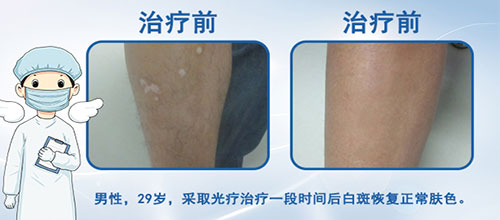 美国极速308nm准分子激光治疗系统成功落户!患者到院可享免费治疗一次!