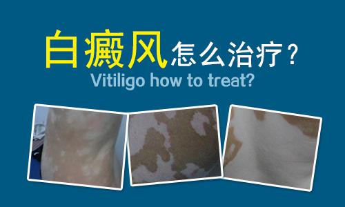 白癜风怎么治疗才能好得快一些”