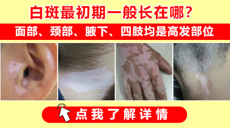 脸上白癜风治疗有什么好的方法