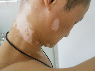 脸上的白癜风怎么治疗好”