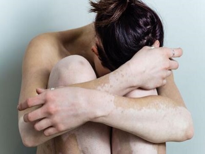 皮肤哪些得白斑小心有白癜风”