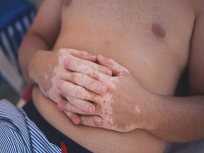 怎么治疗男性患的白癜风”