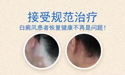 儿童长的白癜风要怎么治呢”