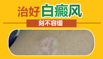 稳定期白癜风有没有自愈的可能