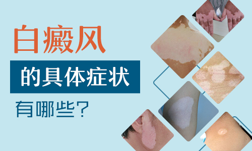 如何可以治背部患的白癜风”