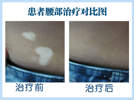 什么是完全性白癜风和不完全性白癜风?