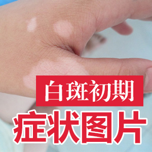 初期的白癜风怎么能治好”
