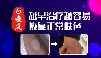 保定专门治疗儿童白癜风的医院