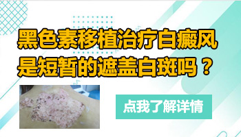 女性得白癜风做308治疗每周照多少次