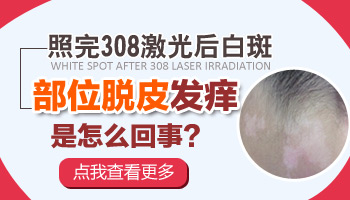 伍德灯检查一大块白色说明就是白癜风吗