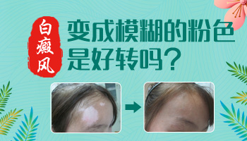 脸部有一片白是白癜风病吗”