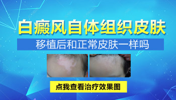 鼻梁上长白癜风该怎么治好”