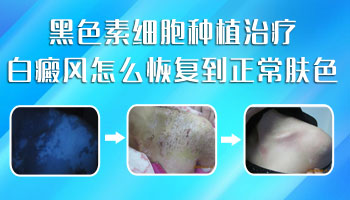 儿子背上有一块白斑扩散了怎么办