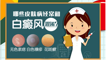 伍德灯下荧光白代表是白癜风吗