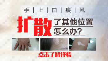 伍德灯下灰白色无荧光