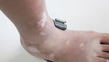 鼻子两侧有白块是白癜风病吗