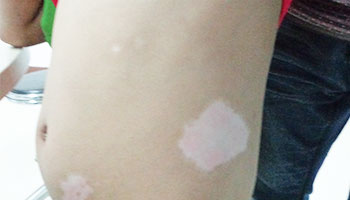 小孩白癜风治疗