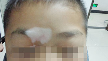 孩子脸上出现了白点是什么问题