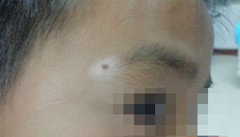 孩子皮肤照伍德灯蓝白色代表什么