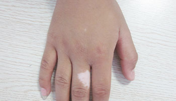 皮肤有白斑给孩子做什么检查能确诊