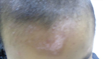 婴幼儿皮肤有白色块怎么回事怎么处理