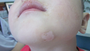 眼角有块皮肤变白就一定是白癜风吗”