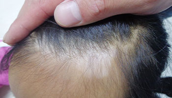 脸蛋上有白点点是白癜风病吗”