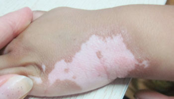 手上皮肤出现白块会不会自己消失