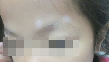 手上长了好多小白斑怎么处理