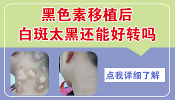 手上的小白斑怎么才能去除